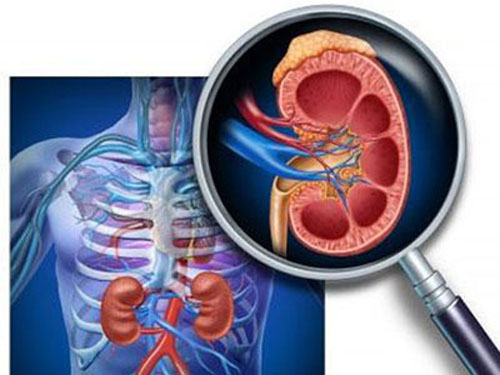 Viêm thận mủ - Hình ảnh minh họa